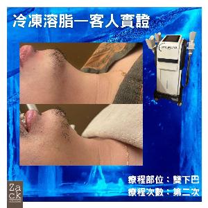 Cryolipolysis 冰感定位纖脂療程(2格)-體驗價